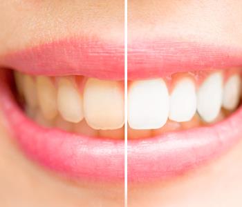 before and after cosmetic dentistry treatment from dentist in Central HK