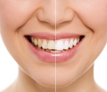 Why professional teeth whitening is preferred by so many Hong Kong patients