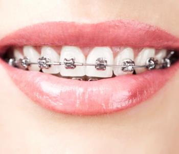 Out of several types of braces for teeth, Invisalign in Hong Kong does more than you may think