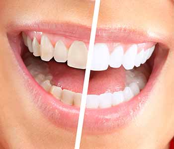 Speak to Dr. Titania Tong, Hong Kong dentist, to learn more about the reasons for gum recession.