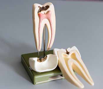 Dentist in Central HK describes the purpose of root canal treatment